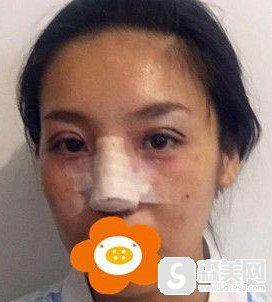 徐陇豫医生翘睫双眼皮加膨体隆鼻案例分享/面部改变到底有多么的突出?