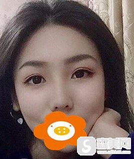 徐陇豫医生翘睫双眼皮加膨体隆鼻案例分享/面部改变到底有多么的突出?