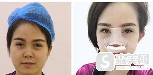 东莞华美詹慧医生的隆鼻怎么样?2021隆鼻价目表曝光
