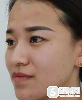 怎样治抬头纹?玻尿酸注射能不能把抬头纹彻底去除?