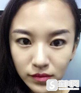 怎样治抬头纹?玻尿酸注射能不能把抬头纹彻底去除?