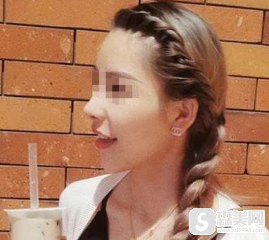 上海华美医疗美容医院隆鼻果和大家分享一下!医生信息,术后对比图