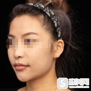 上海华美医疗美容医院隆鼻果和大家分享一下!医生信息,术后对比图