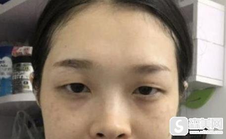 上海港华医疗美容医院做双眼皮的果怎么样？医生信息,分享双眼皮案例