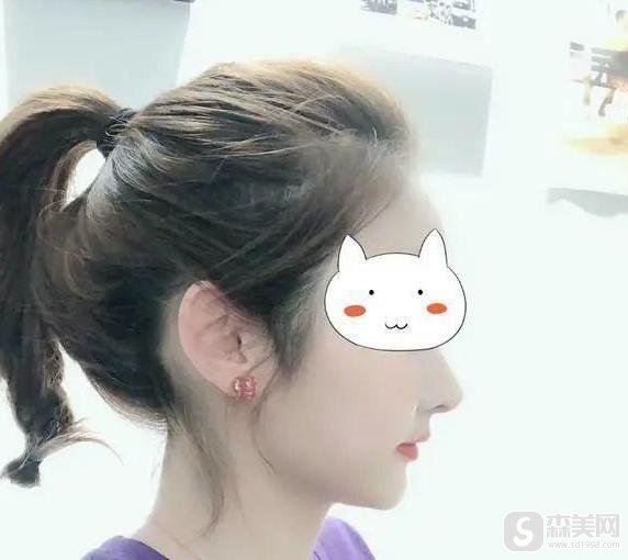 武汉中翰整形外科医院吴中兴医生正颌果怎么样？附正颌术后果图