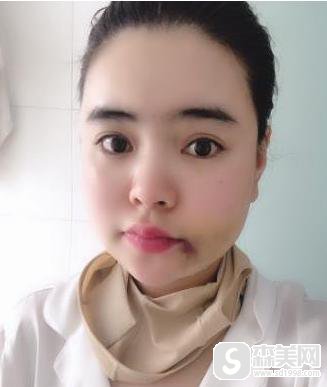 上海华山整形医院穆雄铮医生做磨骨怎么样?医生信息,附术后果图对比