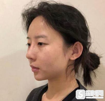 杭州时光整形医院双眼皮手术案例分享！医院信息,提供术后果图浏览
