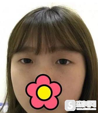 沈阳杏林整形外科医院是公立还是私立医院?医生信息,附双眼皮术后对比图