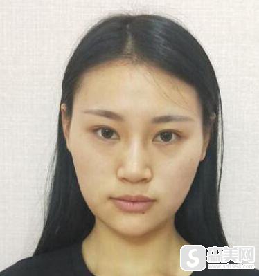 潍坊医学院整形外科医院做隆鼻果好不好？医生信息,分享术后对比图
