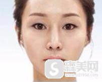 上海首尔丽格磨骨价格多少呢?医生信息,附磨骨术后果图对比