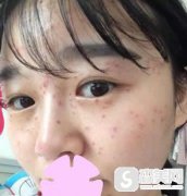 张德勇医生的祛斑果怎么样?真人案例分享