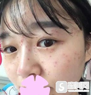 张德勇医生的祛斑果怎么样?真人案例分享