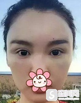 新疆伊丽莎白整形医院实力怎么样?双眼皮和注射瘦脸的案例分享