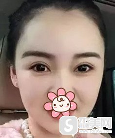 新疆伊丽莎白整形医院实力怎么样?双眼皮和注射瘦脸的案例分享