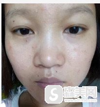 在新疆整形医院找苏炳云做的水光补水真的能够改善皮肤的问题吗?