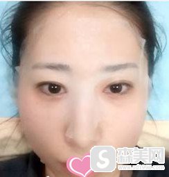 在山西省整形外科医院做的超声提拉 术后反馈附前后对比图