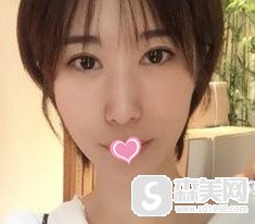 在山西省整形外科医院做的超声提拉 术后反馈附前后对比图