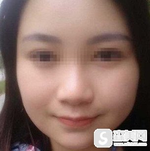 新疆华美王超杰的磨骨整形技术是不是很精湛?术后的果好不好?