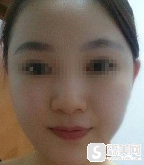 新疆华美王超杰的磨骨整形技术是不是很精湛?术后的果好不好?