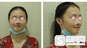 新疆梁青松整形的技术是怎样的风格?隆鼻以后真的能使面部变得立体吗?