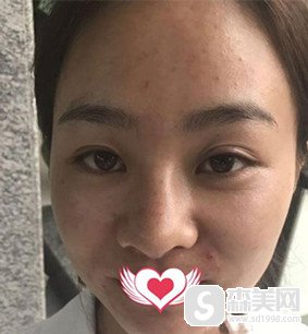 新疆大西北整形医院怎么样?光子嫩肤祛斑的果好不好?案例分享