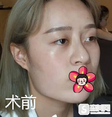 武警三院马福顺下颌角手术怎么样?医院信息,术后果图浏览