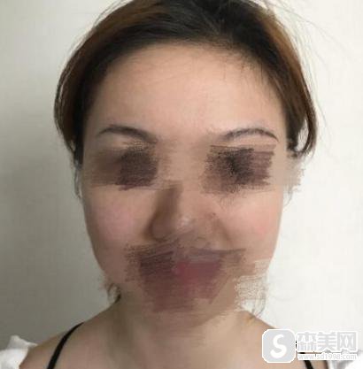 赵贵庆医生磨骨手术案例揭秘!附专家信息及磨骨术后果图