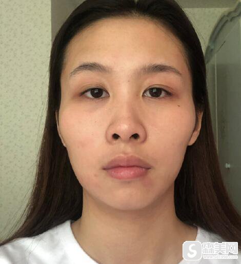 上海的朴兴植做颧骨很厉害吗?附专家信息及真人术后案例!