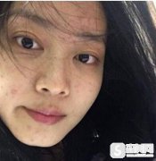 上海华美像素激光去痘坑案例,附真实案例果图