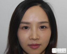 上海中山医院玻尿酸丰唇可以吗?术后嘟嘟唇图片果