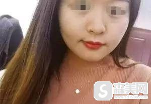 兰秀琴医生进行的果酸换肤是怎样的果?她在整形领域有怎样的实力?