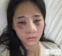 深圳北大医院整形技术好吗?鼻尖整形对比图