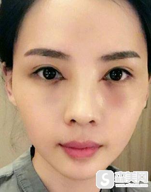 济南中心医院眼部手术做的好吗？什么叫开眼角