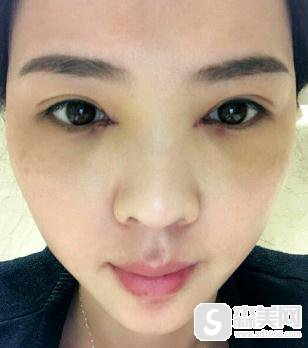 济南中心医院眼部手术做的好吗？什么叫开眼角