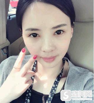 济南中心医院眼部手术做的好吗？什么叫开眼角