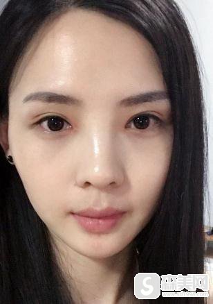 济南中心医院眼部手术做的好吗？什么叫开眼角