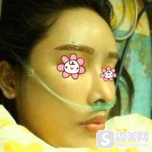 王秀红医生的脂肪填充果怎么样?面部的改变是不是特别大?