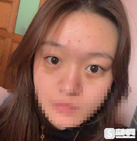 肿泡眼可以抽脂去除吗?真实祛除眼袋案例附术后果图