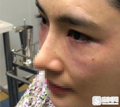 肿泡眼可以抽脂去除吗?真实祛除眼袋案例附术后果图