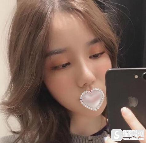 假体隆鼻的前后对比照片？附假体隆鼻案例