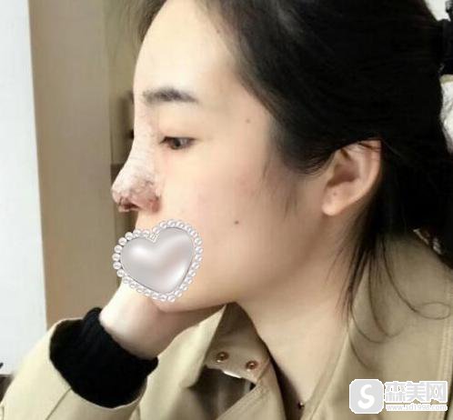 假体隆鼻的前后对比照片？附假体隆鼻案例