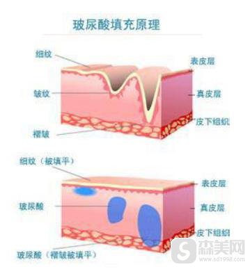 瑞兰玻尿酸注射怎么样？是长期的么？附术后注意事项