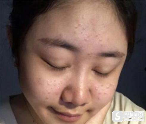 美联臣整形医院激光祛痘怎么样？专家介绍和案例分享