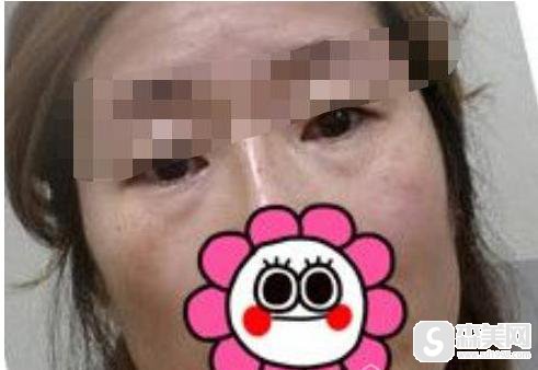 北京去眼袋手术后果怎么样？医生信息,附术后果图