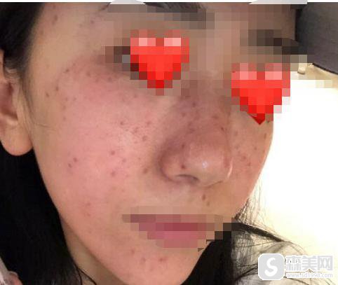 北京艺星激光祛斑如何？医生信息,附真实案例
