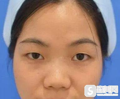 双眼皮手术前后对比图！附真实案例提供大家观看