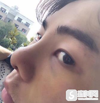 男士隆鼻!术后果对比图,真实案例让大家浏览