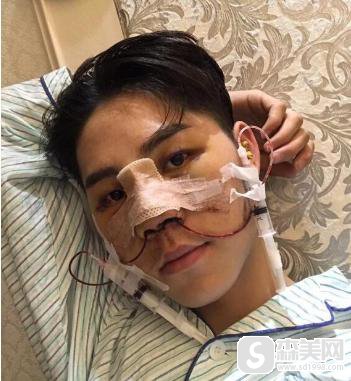 男士隆鼻!术后果对比图,真实案例让大家浏览