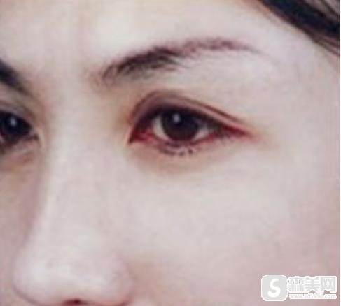 蒋正华做的热玛吉果如何?医生信息,附热玛吉术后果