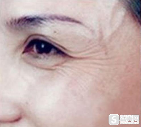 蒋正华做的热玛吉果如何?医生信息,附热玛吉术后果